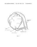 METHOD AND APPARATUS FOR EFFECTING AN AORTIC VALVE BYPASS, INCLUDING THE     PROVISION AND USE OF A T-STENT FOR EFFECTING A DISTAL ANASTOMOSIS FOR THE     SAME diagram and image