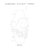 FLEX ANCHOR FOR ATTACHING A PROSTHESIS TO BONE diagram and image