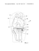 PROSTHESIS AND IMPLEMENTATION SYSTEM diagram and image