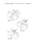 PROSTHESIS AND IMPLEMENTATION SYSTEM diagram and image