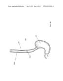 STENT SYSTEM AND METHODS OF USE diagram and image