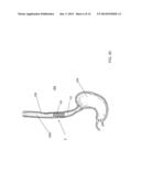 STENT SYSTEM AND METHODS OF USE diagram and image