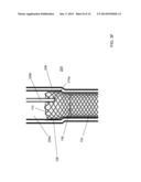 STENT SYSTEM AND METHODS OF USE diagram and image