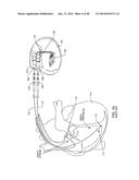 CO-FIRED HERMETICALLY SEALED FEEDTHROUGH WITH ALUMINA SUBSTRATE AND     PLATINUM FILLED VIA FOR AN ACTIVE IMPLANTABLE MEDICAL DEVICE diagram and image