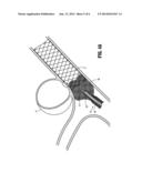 MICROCATHETER diagram and image