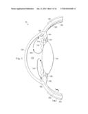 SUPRACHORIODAL DRAINAGE TUBE IN A FLOW CONTROL SYSTEM diagram and image