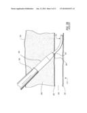 MEDICAL GUIDE ELEMENT WITH DIAMETER TRANSITION diagram and image