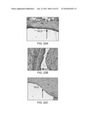 IRREVERSIBLE ELECTROPORATION DEVICE AND METHOD FOR ATTENUATING NEOINTIMAL     FORMATION diagram and image