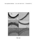 IRREVERSIBLE ELECTROPORATION DEVICE AND METHOD FOR ATTENUATING NEOINTIMAL     FORMATION diagram and image