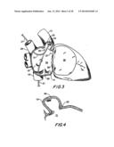 FILTER APPARATUS FOR OSTIUM OF LEFT ATRIAL APPENDAGE diagram and image