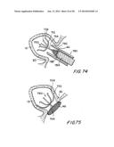 FILTER APPARATUS FOR OSTIUM OF LEFT ATRIAL APPENDAGE diagram and image