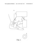 MINIMALLY INVASIVE IMPLANTABLE NEUROSTIMULATION SYSTEM diagram and image