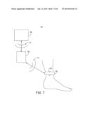 MINIMALLY INVASIVE IMPLANTABLE NEUROSTIMULATION SYSTEM diagram and image