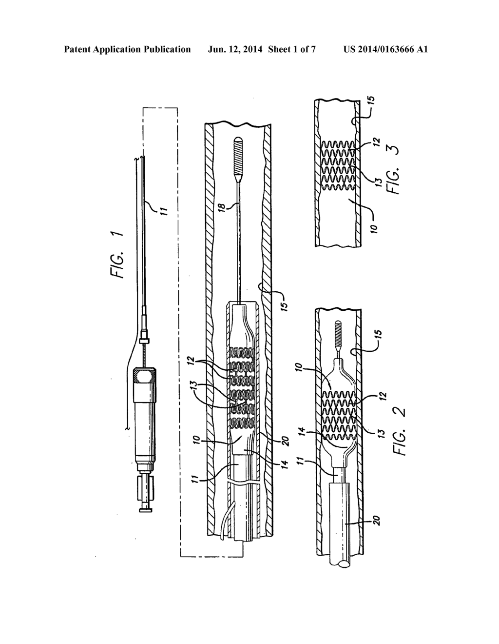 INTRAVASCULAR STENT - diagram, schematic, and image 02