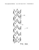 PREFORM FOR AND AN ENDOLUMINAL PROSTHESIS diagram and image