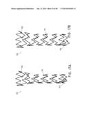 PREFORM FOR AND AN ENDOLUMINAL PROSTHESIS diagram and image