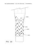 PREFORM FOR AND AN ENDOLUMINAL PROSTHESIS diagram and image