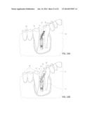 DEVICE, SYSTEM AND METHOD FOR PROSTHODONTIC RESTORATION diagram and image