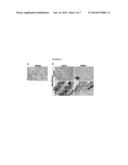 BIOMARKER OF ASBESTOS EXPOSURE AND MESOTHELIOMA diagram and image