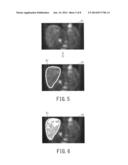 NUCLEAR MEDICINE DIAGNOSTIC APPARATUS, DIAGNOSTIC IMAGING APPARATUS, AND     IMAGE PROCESSING METHOD diagram and image