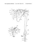 SHOULDER ORTHOSIS diagram and image