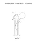 BONE RASP APPARATUS AND METHOD diagram and image