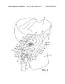 External Tibial Mill Guide and Method of Use diagram and image