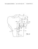 External Tibial Mill Guide and Method of Use diagram and image