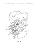 External Tibial Mill Guide and Method of Use diagram and image