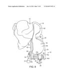 External Tibial Mill Guide and Method of Use diagram and image