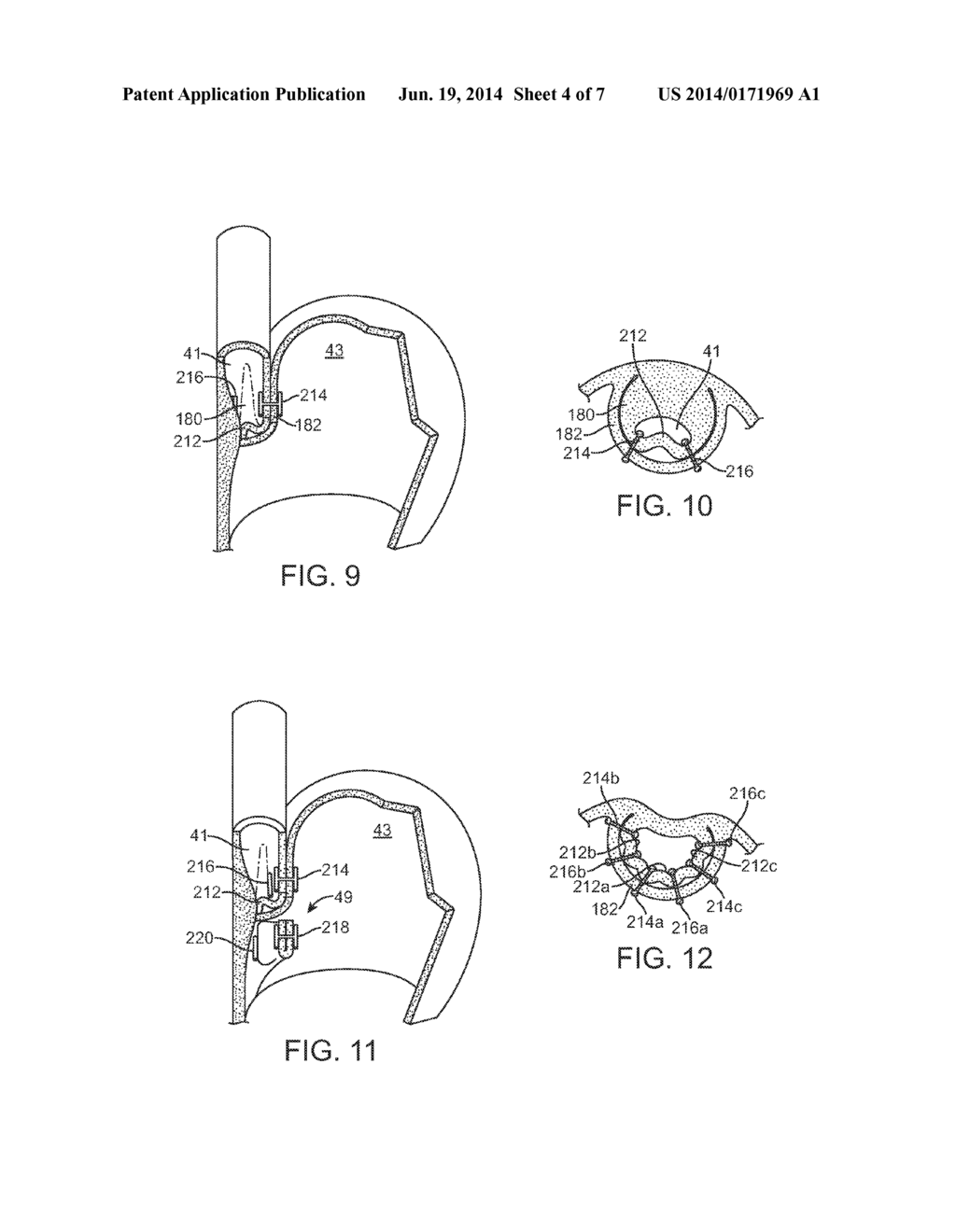 APPARATUS AND METHOD FOR CONCURRENTLY FORMING A GASTROESOPHAGEAL VALVE AND     TIGHTENING THE LOWER ESOPHAGEAL SPHINCTER - diagram, schematic, and image 05