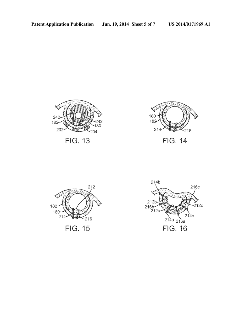 APPARATUS AND METHOD FOR CONCURRENTLY FORMING A GASTROESOPHAGEAL VALVE AND     TIGHTENING THE LOWER ESOPHAGEAL SPHINCTER - diagram, schematic, and image 06