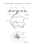 ASSEMBLY AND METHOD FOR LEFT ATRIAL APPENDAGE OCCLUSION diagram and image