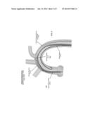 SYSTEM FOR FACILITATING TRANSCATHETER AORTIC VALVE PROCEDURES USING     FEMORAL ACCESS diagram and image