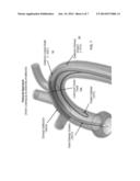 SYSTEM FOR FACILITATING TRANSCATHETER AORTIC VALVE PROCEDURES USING     FEMORAL ACCESS diagram and image