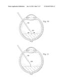 FINE MEMBRANE FORCEPS WITH INTEGRAL SCRAPING FEATURE diagram and image