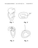 Delivery Device For Medical Implant And Medical Procedure diagram and image