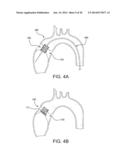 MULTI-FRAME PROSTHETIC HEART VALVE diagram and image