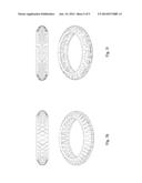 Capsule Expander Devices, Systems, and Methods for Inhibiting Capsular     Opacification and Stabilizing the Capsule diagram and image