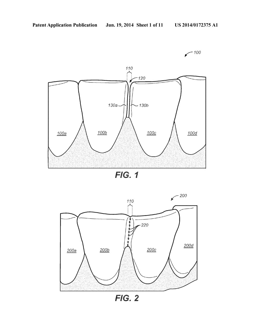 CREATING A DIGITAL DENTAL MODEL OF A PATIENT'S TEETH USING INTERPROXIMAL     INFORMATION - diagram, schematic, and image 02