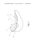 Mouthguard Magnetic Retention System diagram and image