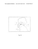 Mouthguard Magnetic Retention System diagram and image