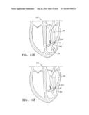 SYSTEMS AND METHODS FOR IMPROVING CARDIAC FUNCTION diagram and image