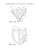 SYSTEMS AND METHODS FOR IMPROVING CARDIAC FUNCTION diagram and image