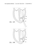 SYSTEMS AND METHODS FOR IMPROVING CARDIAC FUNCTION diagram and image