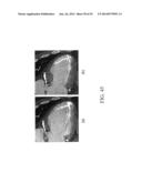 SYSTEMS AND METHODS FOR IMPROVING CARDIAC FUNCTION diagram and image