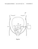 ELECTROPHYSIOLOGICAL MONITORING OF UTERINE CONTRACTIONS diagram and image