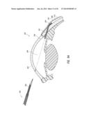 INTRAOCULAR SHUNT PLACEMENT diagram and image