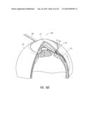 INTRAOCULAR SHUNT PLACEMENT diagram and image