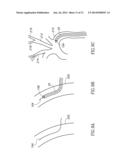 VARIABLE LENGTH CATHETER FOR DRUG DELIVERY diagram and image